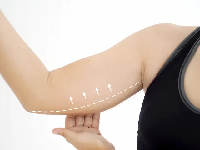 Lose Arm Fat With Ultrasound Liposuction