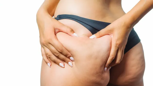 What is Cellulite?
